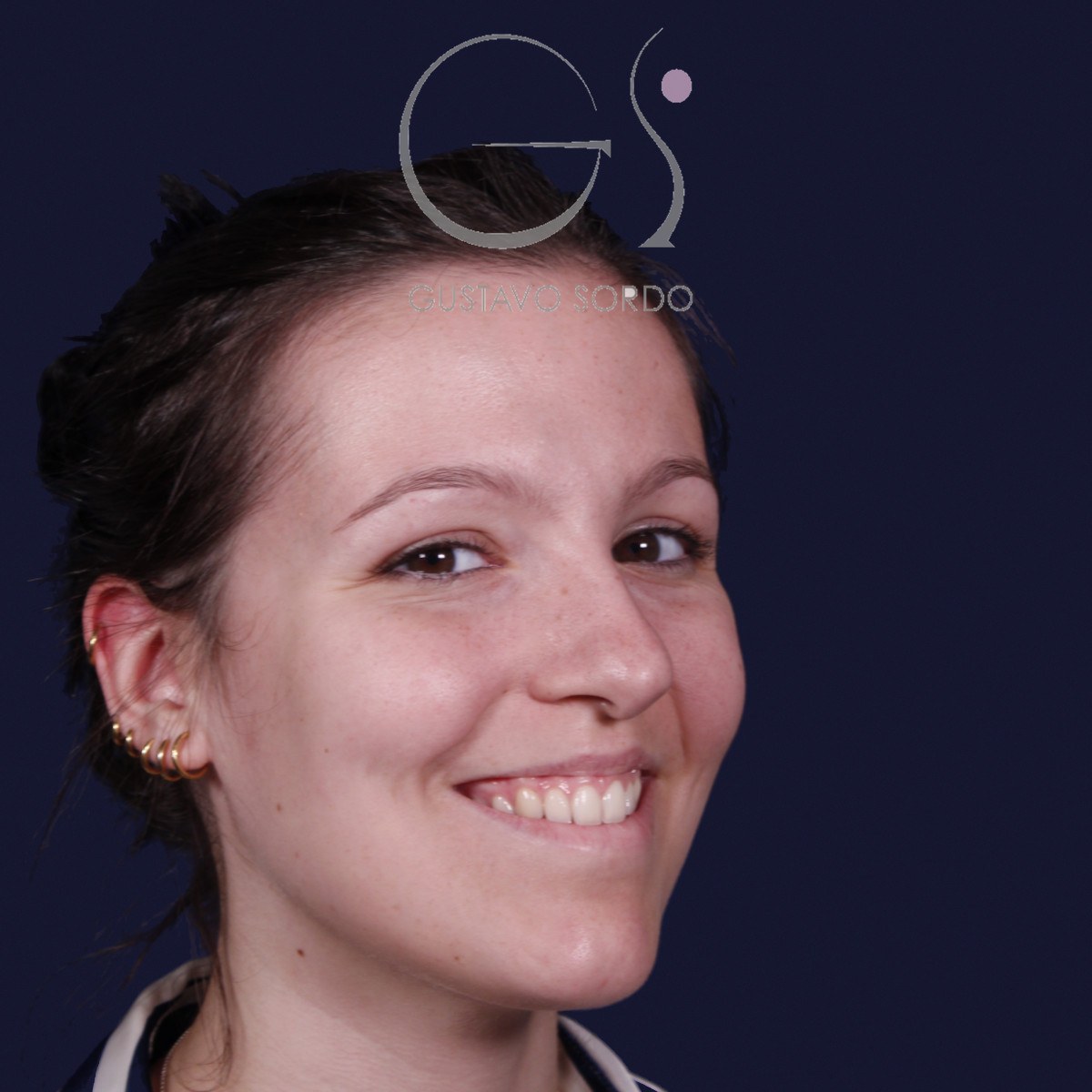 Rinoplastia ultrasónica con giba y punta ancha, semiperfil derecho sonriendo: antes de la operación