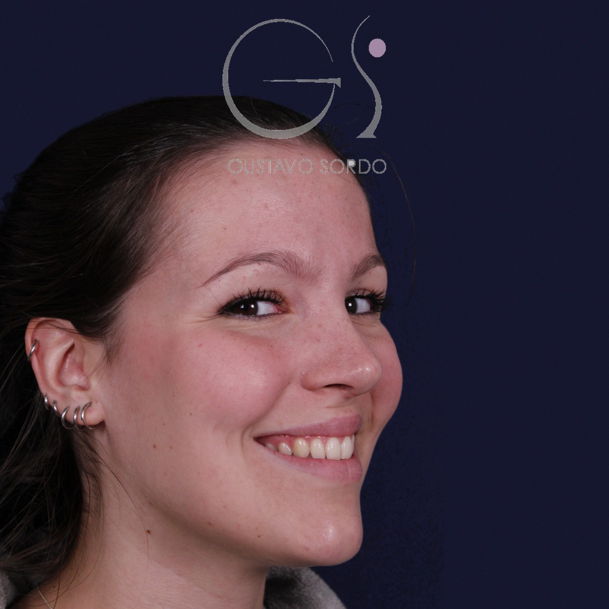 Rinoplastia ultrasónica con giba y punta ancha, semiperfil derecho sonriendo: resultado a los 4 meses