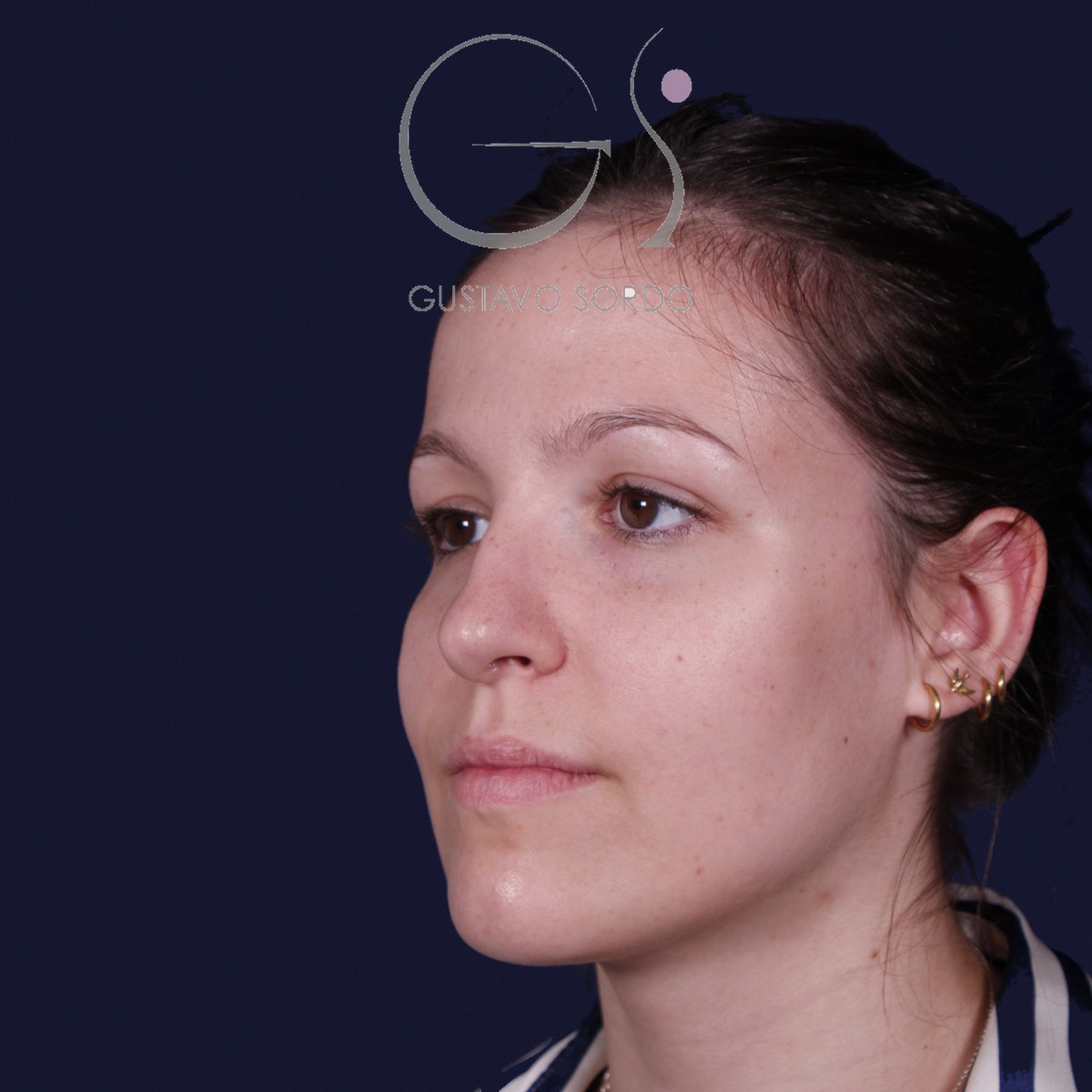 Rinoplastia ultrasónica con giba y punta ancha, semiperfil izquierdo: antes de la operación