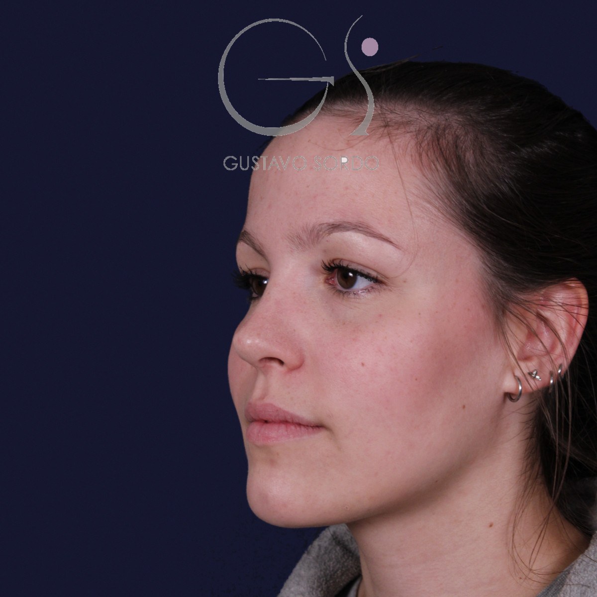 Rinoplastia ultrasónica con giba y punta ancha, semiperfil izquierdo: resultado a los 4 meses