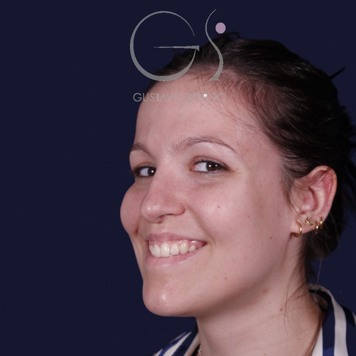 Rinoplastia ultrasónica con giba y punta ancha, semiperfil izquierdo sonriendo: antes de la operación