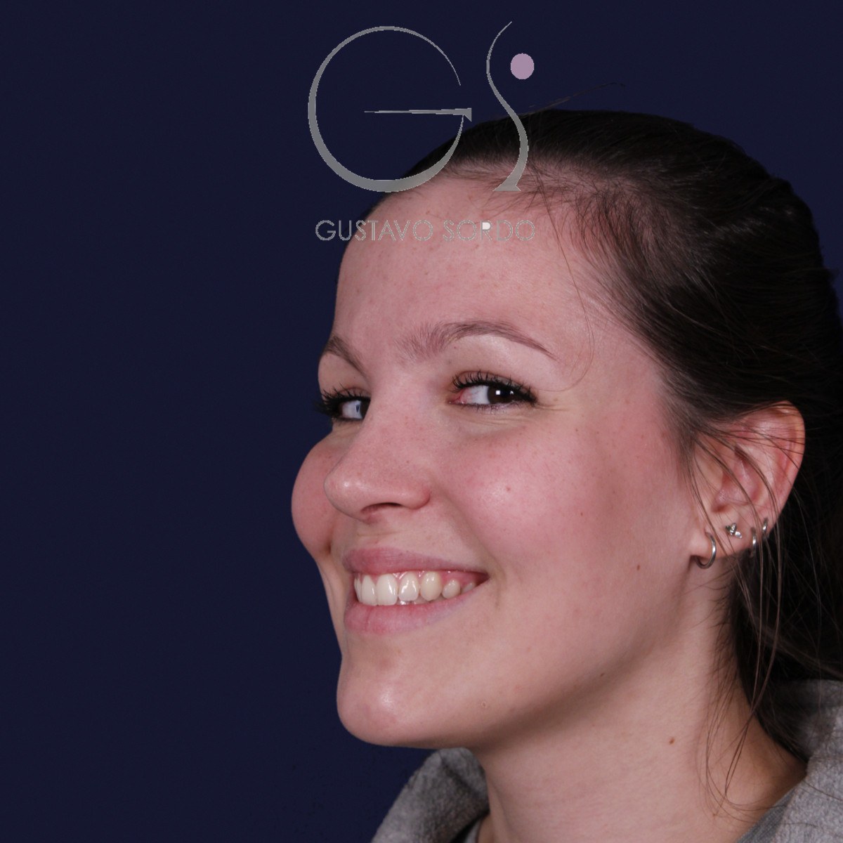 Rinoplastia ultrasónica con giba y punta ancha, semiperfil izquierdo sonriendo: resultado a los 4 meses