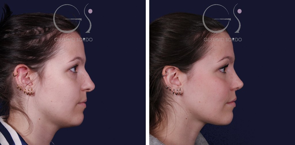 Rinoplastia ultrasónica con giba y punta ancha: antes y después de un caso operado en Madrid
