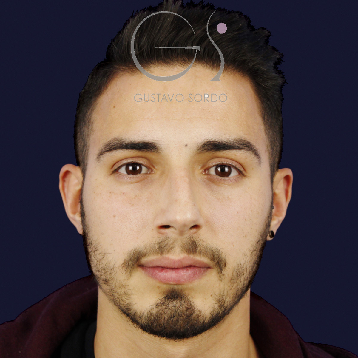 Antes de rinoplastia en hombre con caballete y nariz desviada, vista frontal