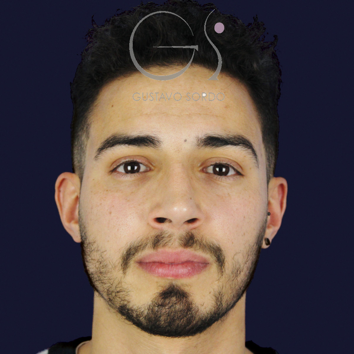 Después de rinoplastia en hombre con caballete y nariz desviada, a los once meses, vista frontal