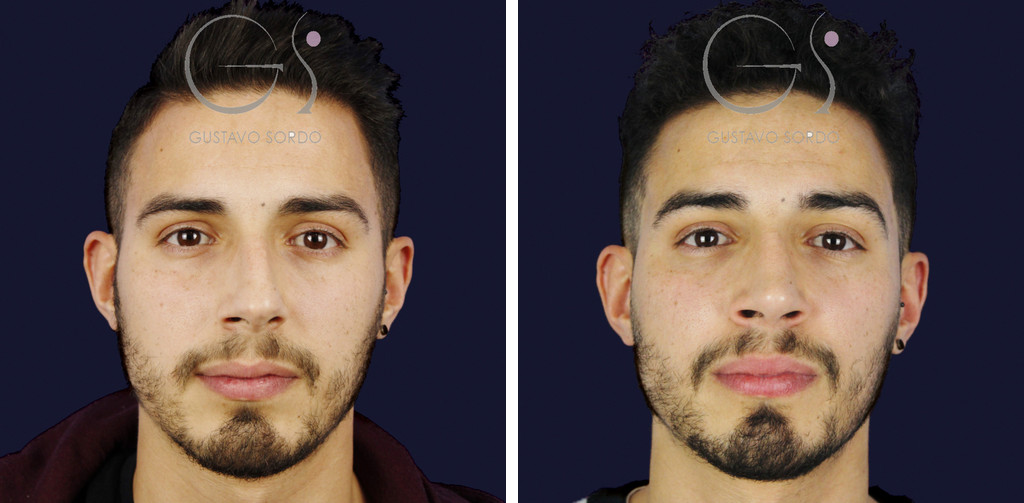Rinoplastia en hombre con caballete y nariz desviada: antes y a los once meses, vista frontal