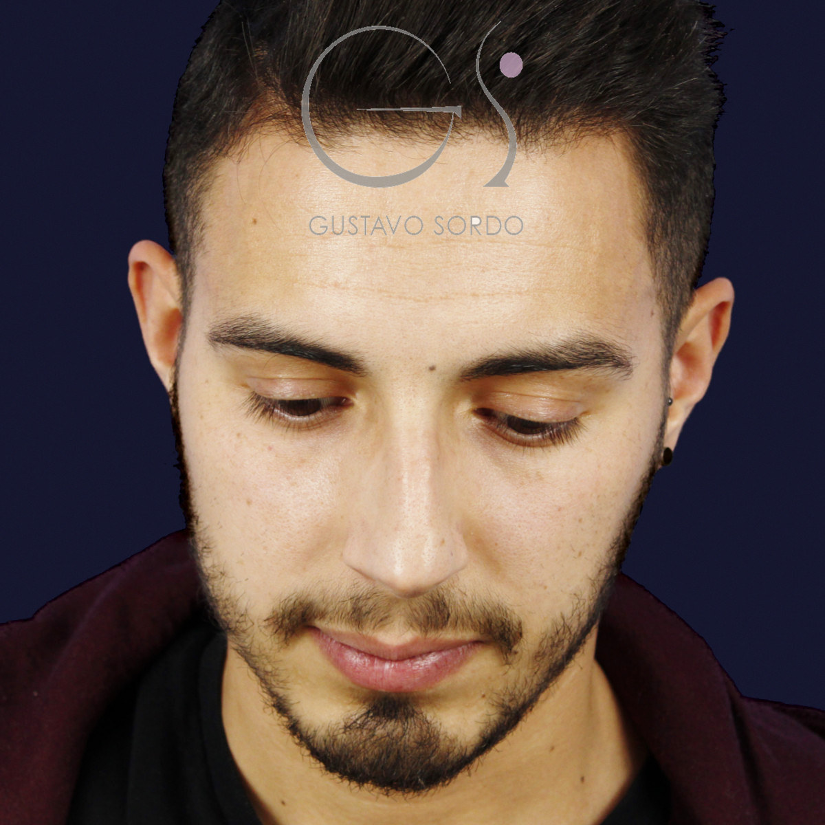 Antes de rinoplastia en hombre con caballete y nariz desviada, vista frontal con el mentón abajo