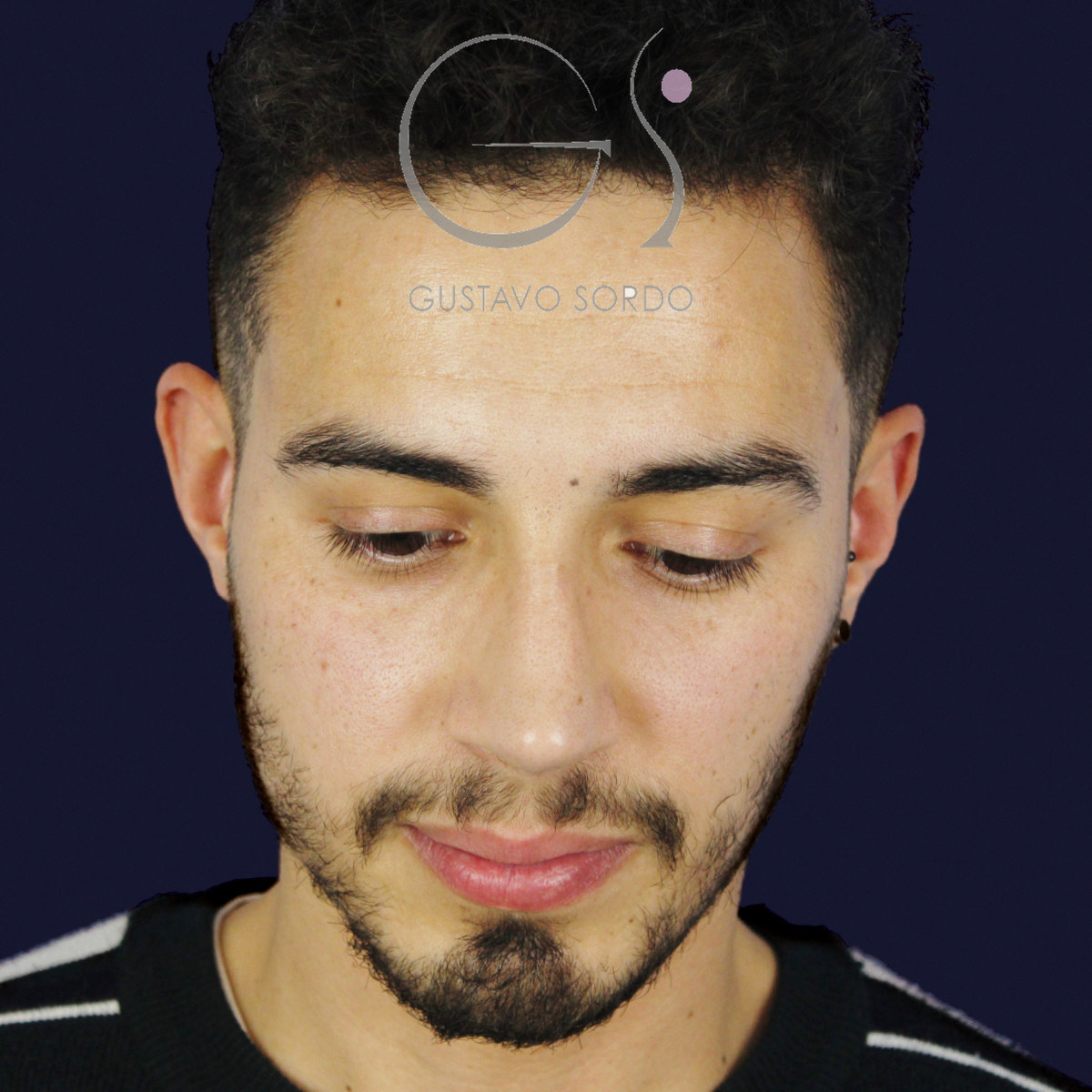 Después de rinoplastia en hombre con caballete y nariz desviada, a los once meses, vista frontal con el mentón abajo