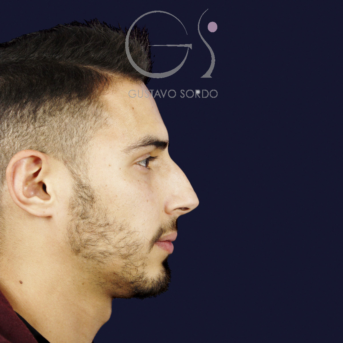 Antes de rinoplastia en hombre con caballete y nariz desviada, vista de perfil derecho