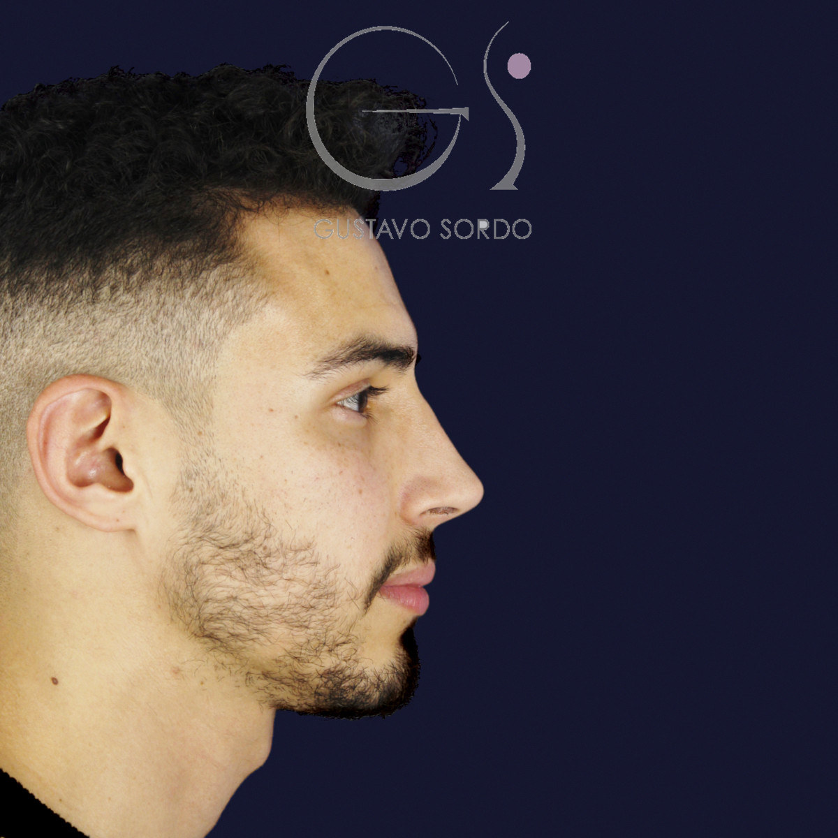 Después de rinoplastia en hombre con caballete y nariz desviada, a los once meses, vista de perfil derecho