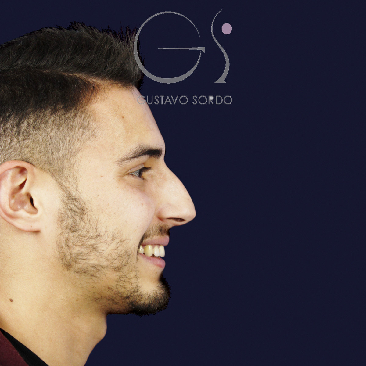 Antes de rinoplastia en hombre con caballete y nariz desviada, vista de perfil derecho sonriendo