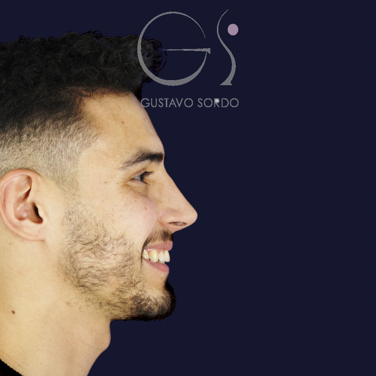 Después de rinoplastia en hombre con caballete y nariz desviada, a los once meses, vista de perfil derecho sonriendo
