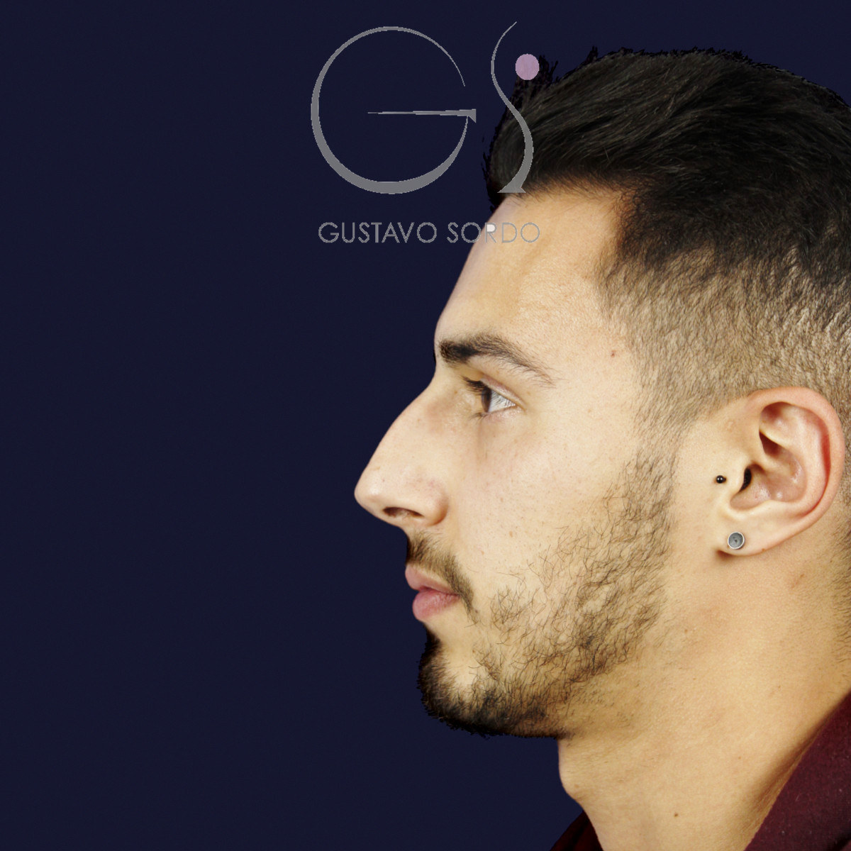 Antes de rinoplastia en hombre con caballete y nariz desviada, vista de perfil izquierdo