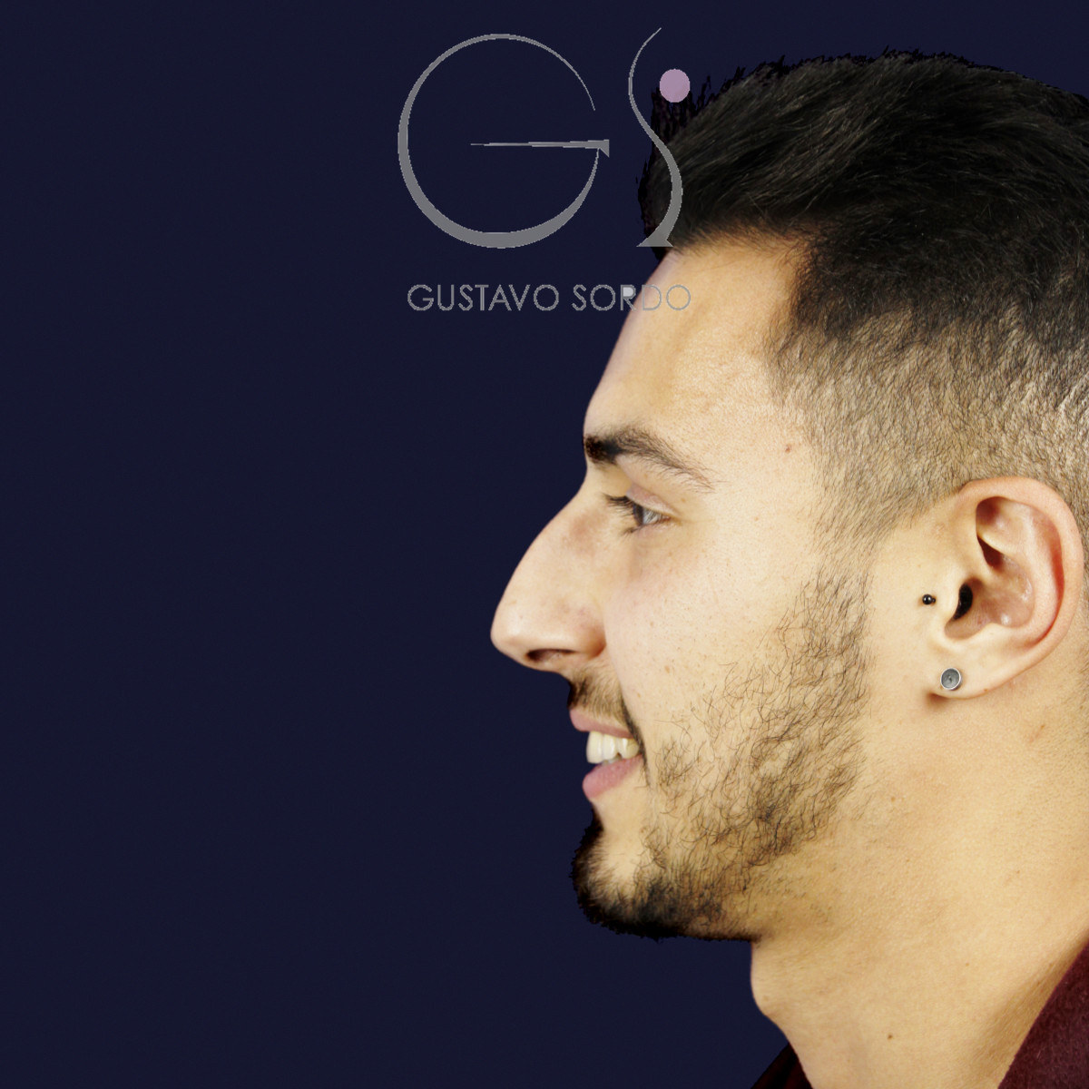 Antes de rinoplastia en hombre con caballete y nariz desviada, vista de perfil izquierdo sonriendo