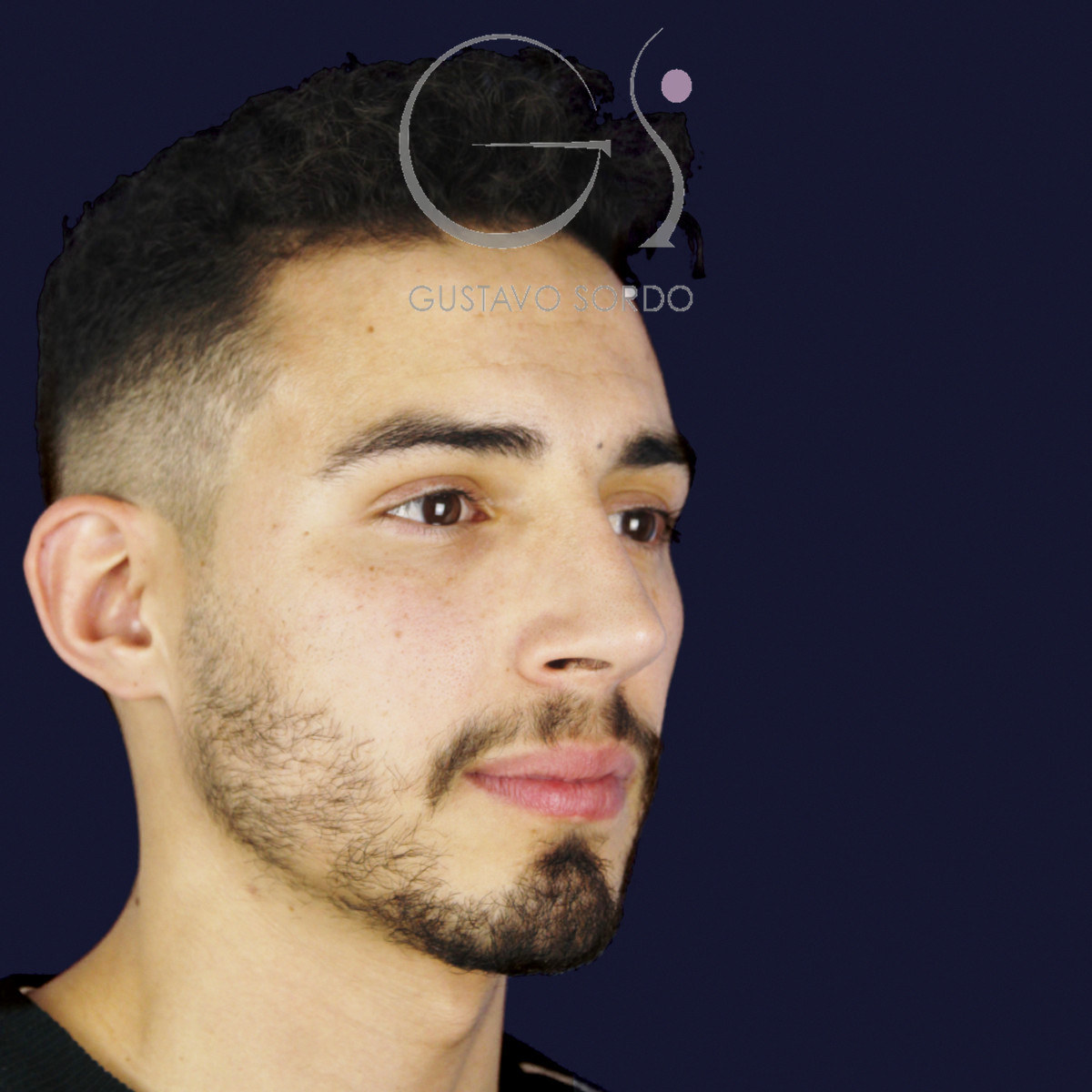 Después de rinoplastia en hombre con caballete y nariz desviada, a los once meses, vista de semiperfil derecho