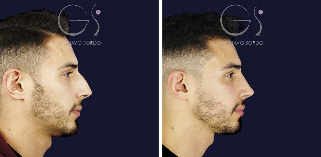 Rinoplastia en hombre con caballete y nariz desviada: antes y a los once meses, perfil derecho