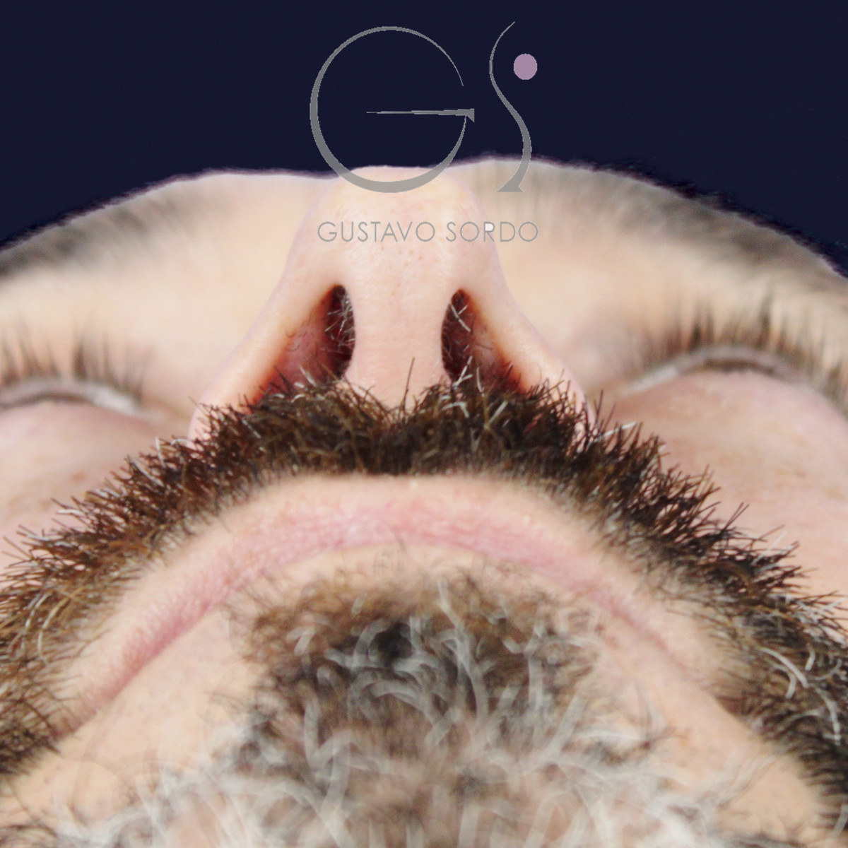 Antes de rinoplastia funcional en hombre con punta caída, vista basal, desde abajo