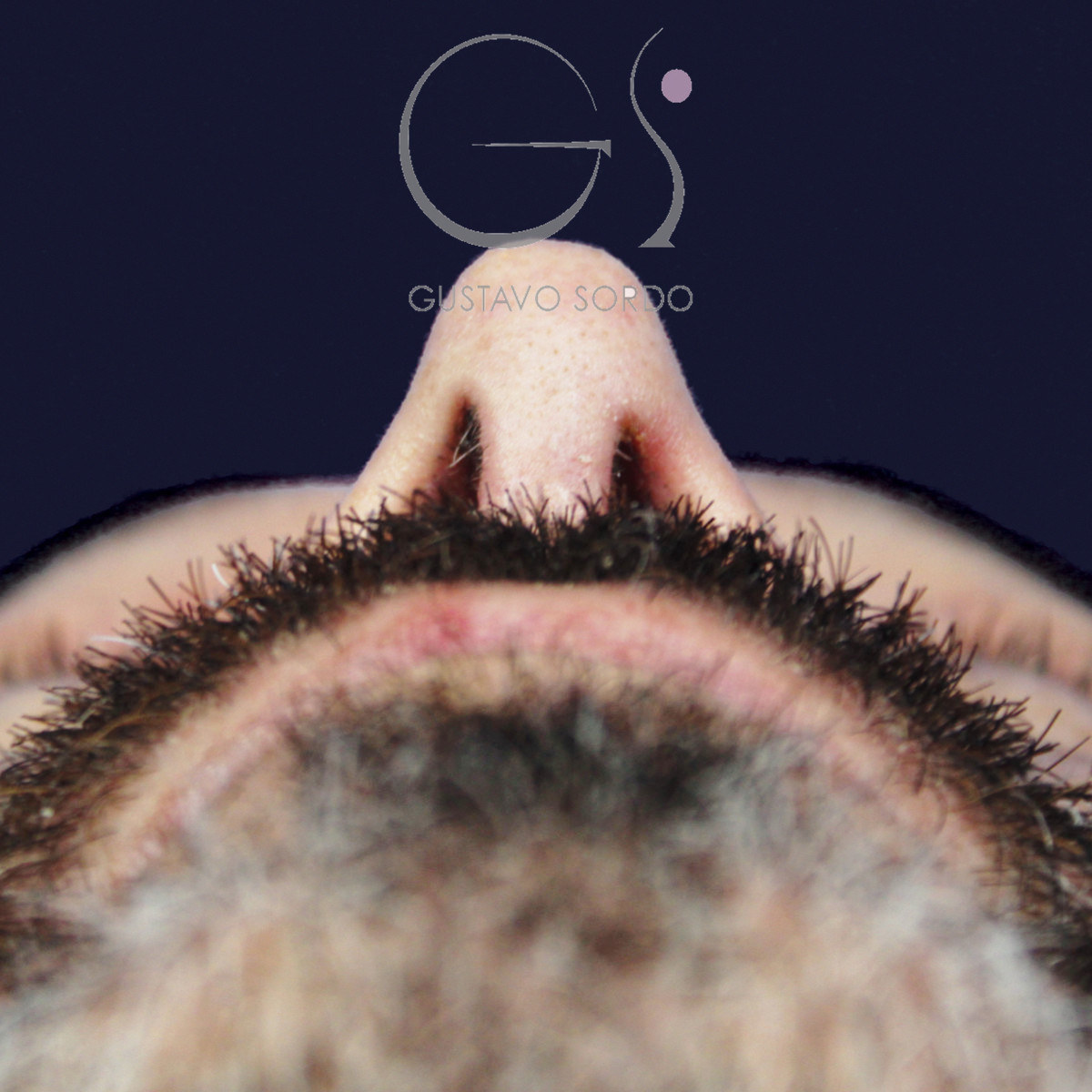 Después de rinoplastia funcional en hombre con punta caída, a los siete meses, vista basal, desde abajo