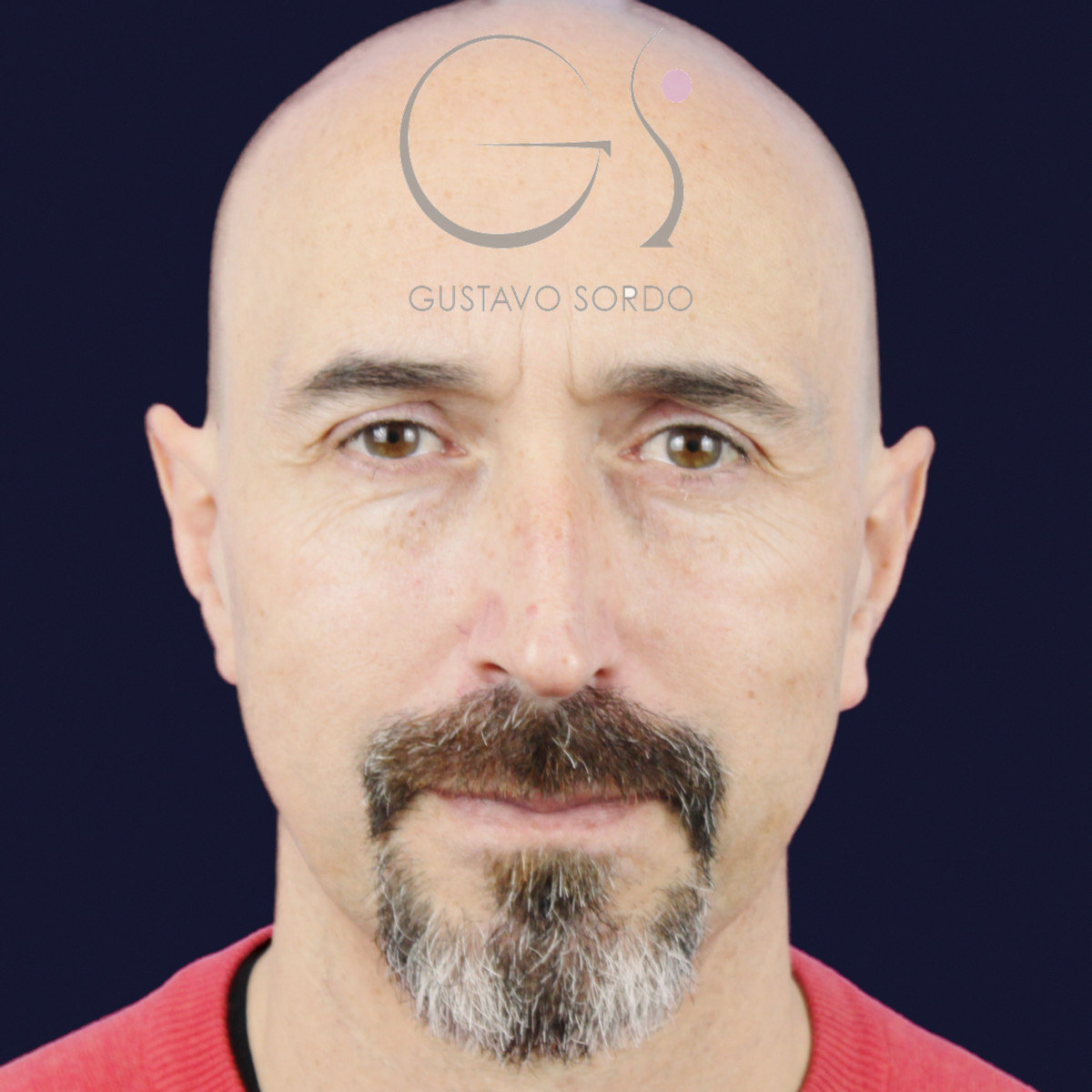 Antes de rinoplastia funcional en hombre con punta caída, vista frontal