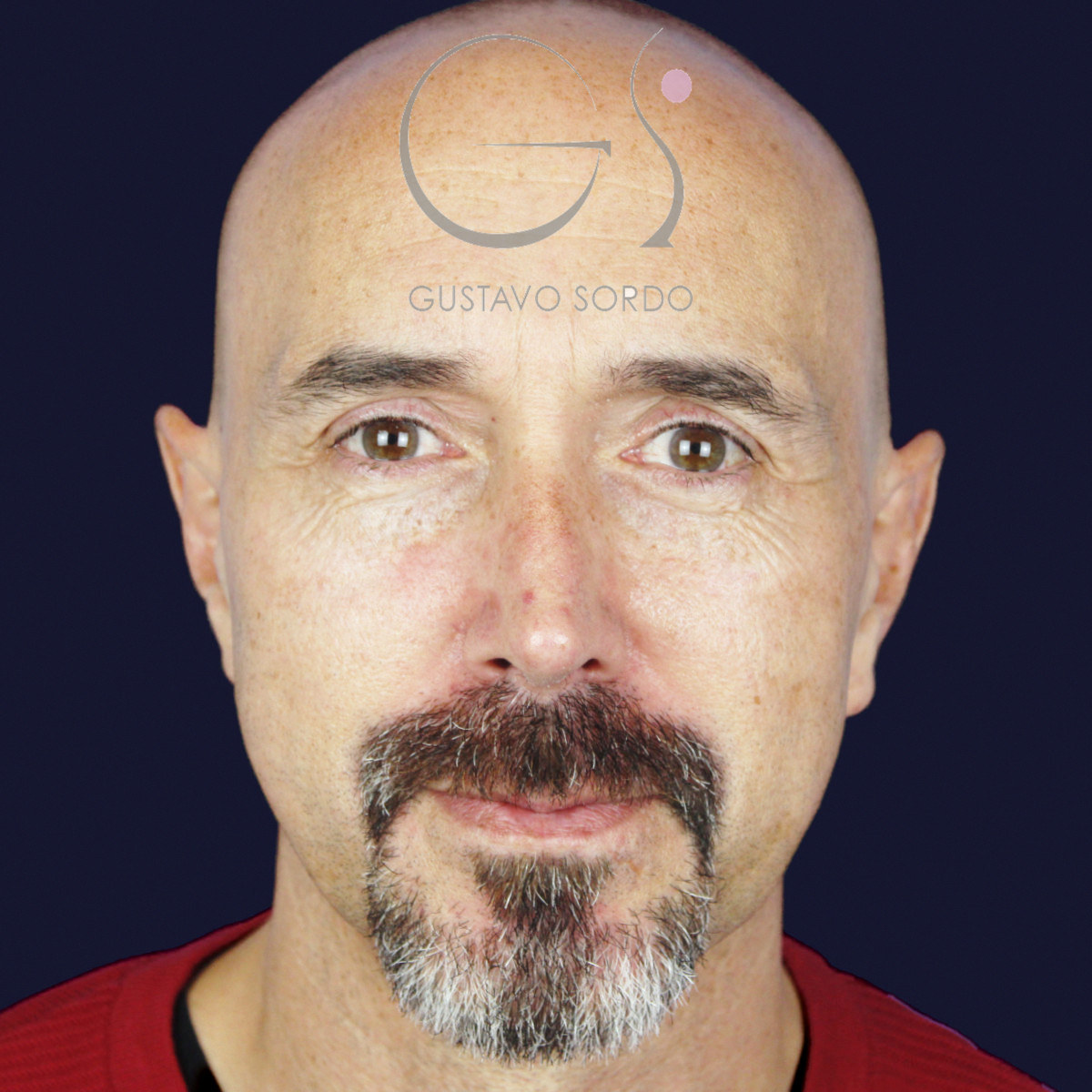 Después de rinoplastia funcional en hombre con punta caída, a los siete meses, vista frontal