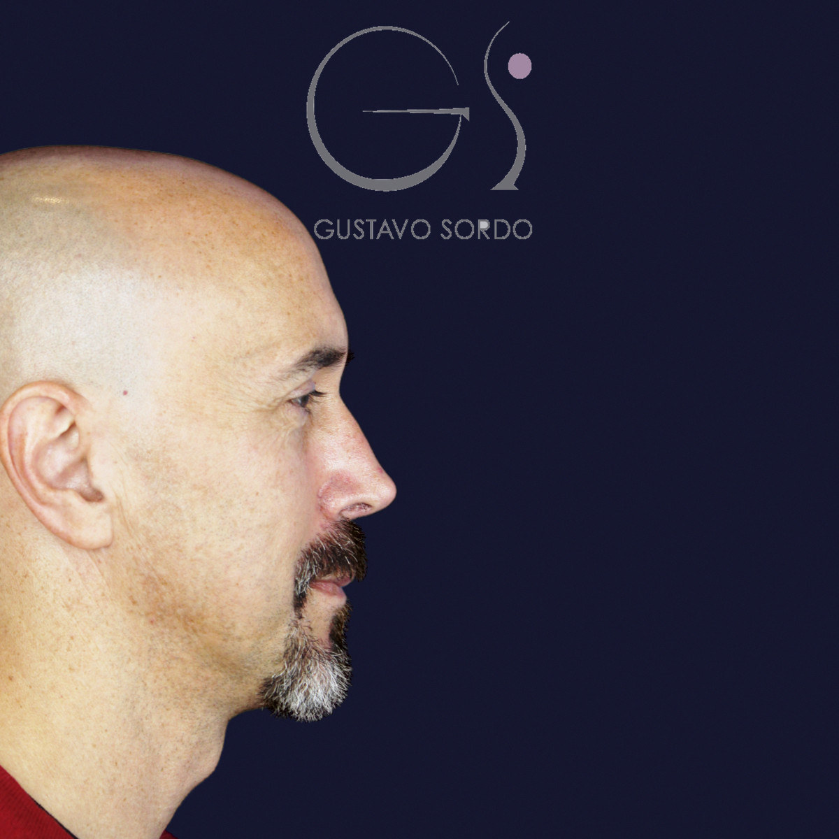 Después de rinoplastia funcional en hombre con punta caída, a los siete meses, vista de perfil derecho