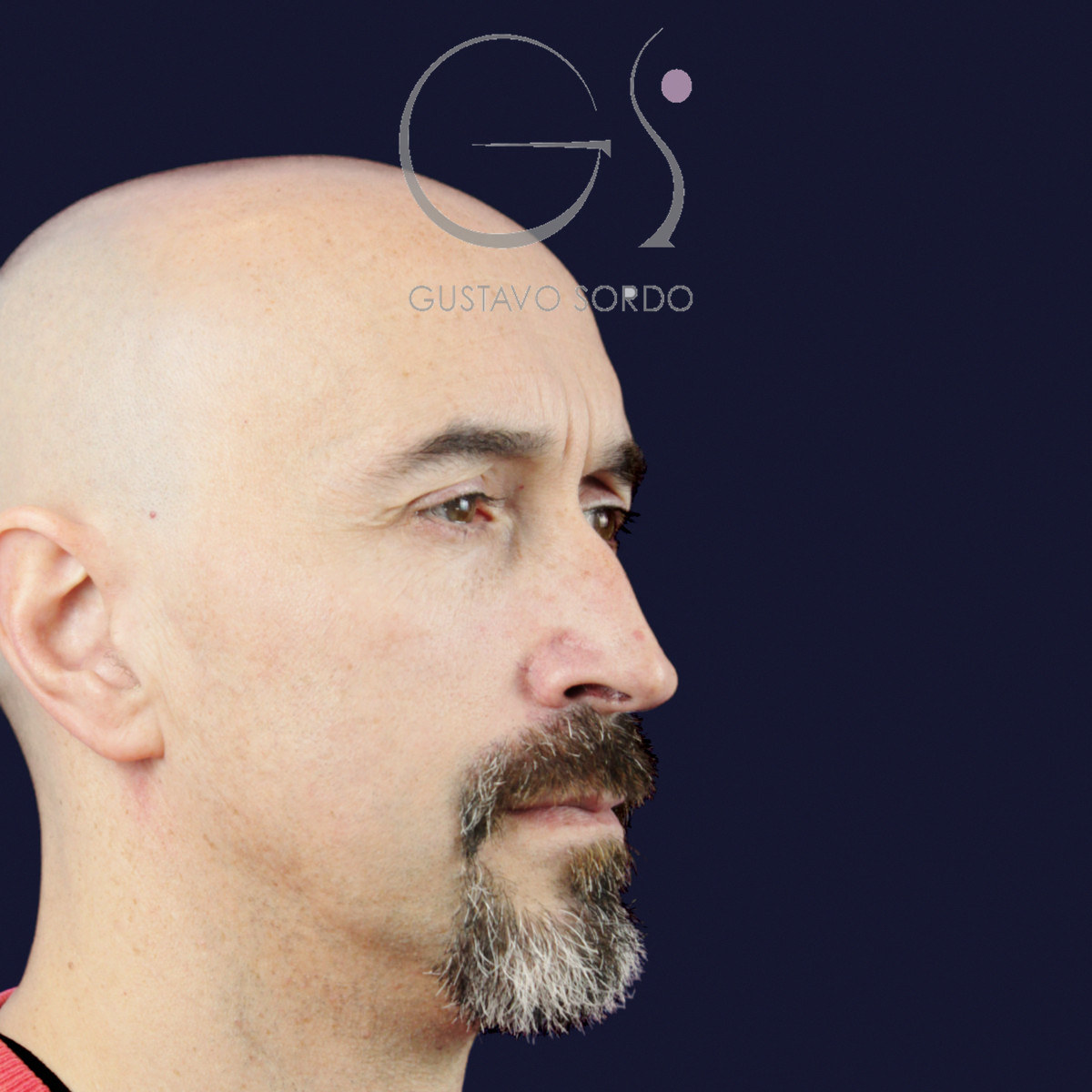 Antes de rinoplastia funcional en hombre con punta caída, vista de semiperfil derecho
