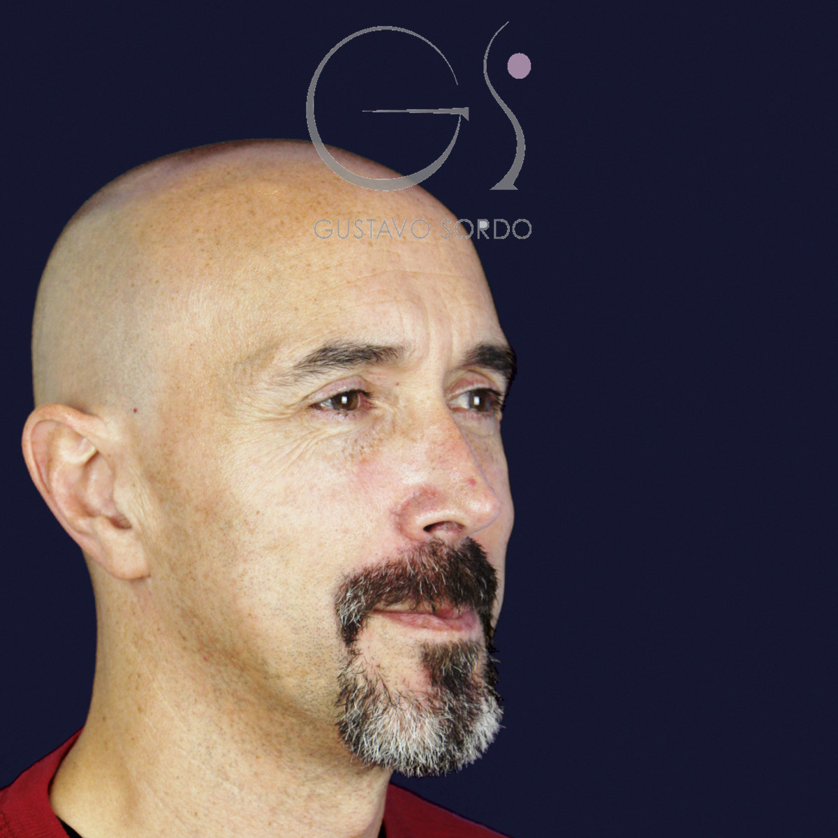 Después de rinoplastia funcional en hombre con punta caída, a los siete meses, vista de semiperfil derecho