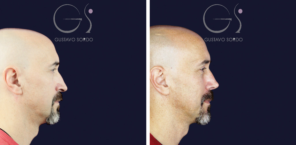 Rinoplastia funcional en hombre con punta caída: antes y a los siete meses, perfil derecho