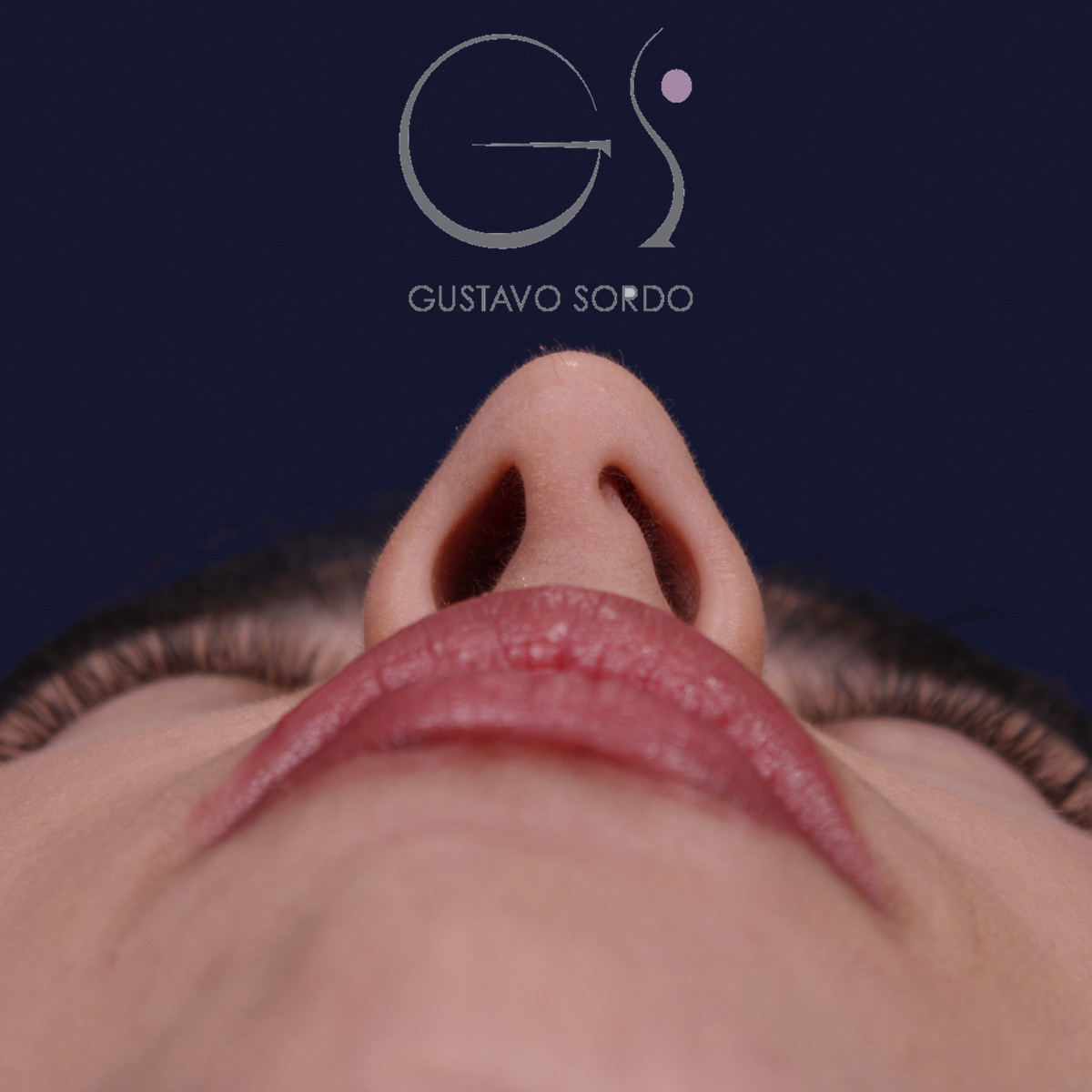 Rinoplastia ultrasónica con tabique desviado y mentoplastia, vista basal, antes de la cirugía — caso del Dr. Gustavo Sordo en Madrid