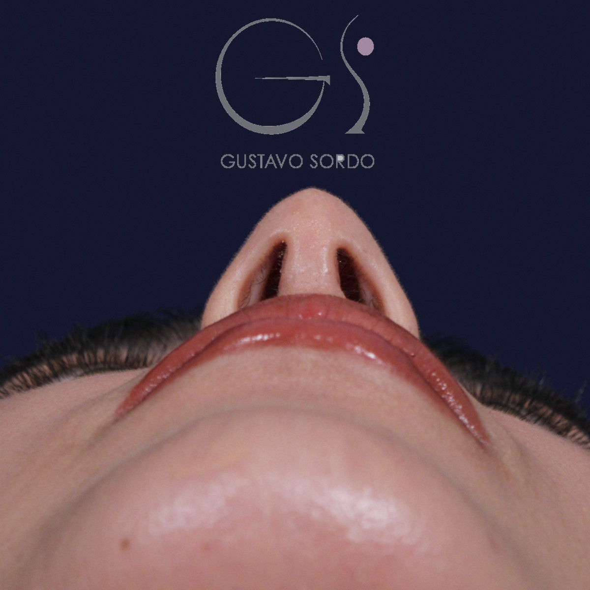 Rinoplastia ultrasónica con tabique desviado y mentoplastia, vista basal, al año de la cirugía — caso del Dr. Gustavo Sordo en Madrid
