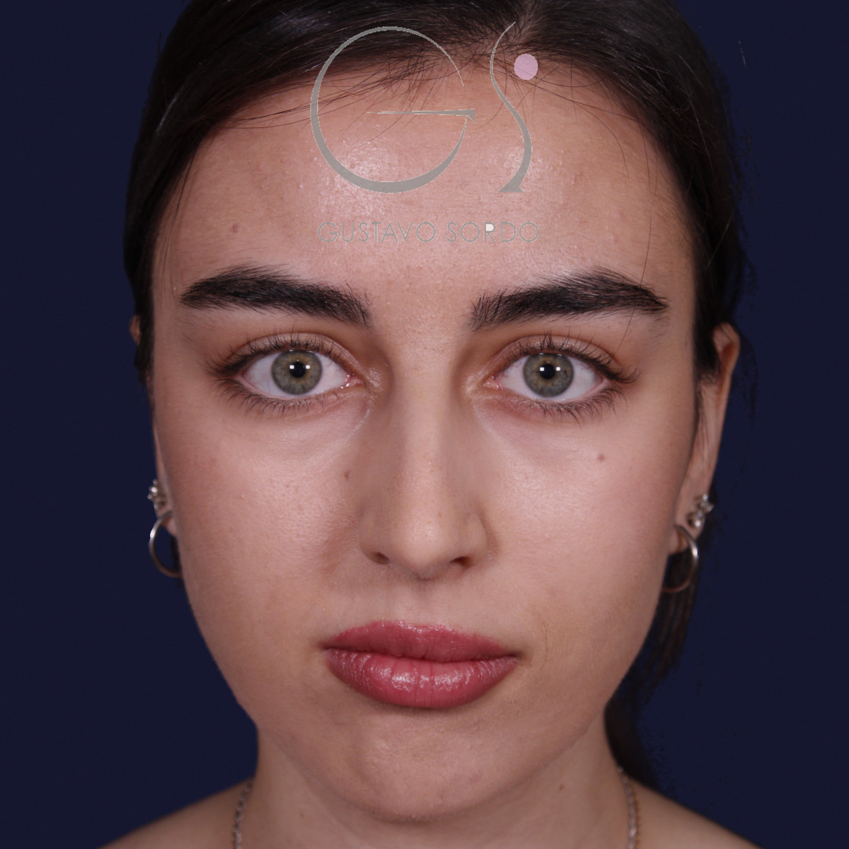 Rinoplastia ultrasónica con tabique desviado y mentoplastia, vista frontal, antes de la cirugía — caso del Dr. Gustavo Sordo en Madrid