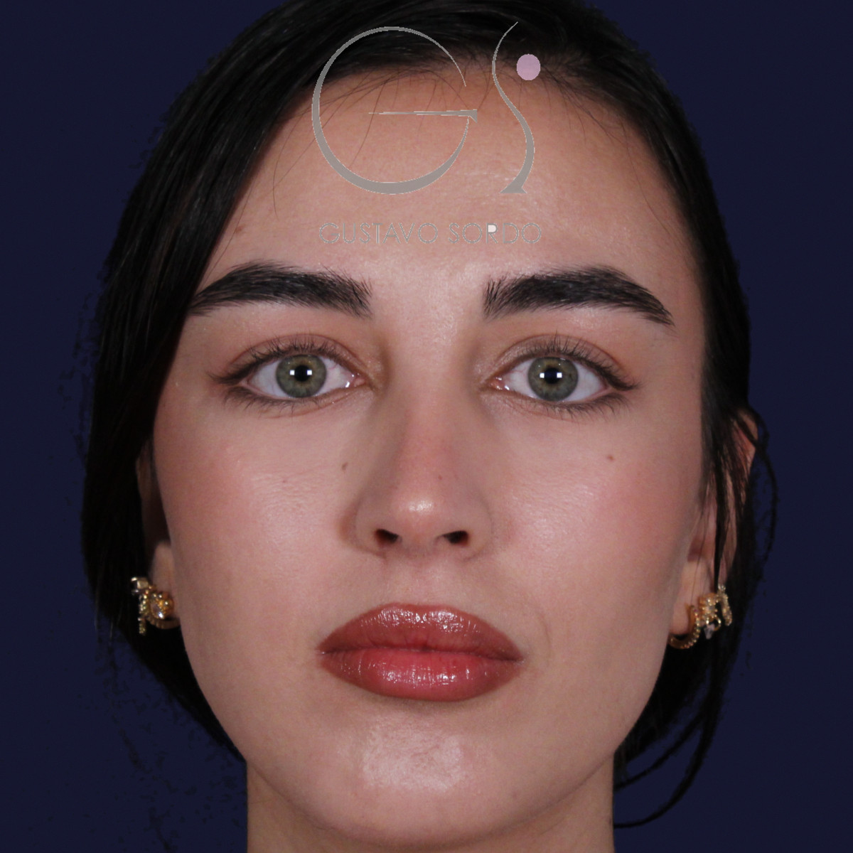 Rinoplastia ultrasónica con tabique desviado y mentoplastia, vista frontal, al año de la cirugía — caso del Dr. Gustavo Sordo en Madrid