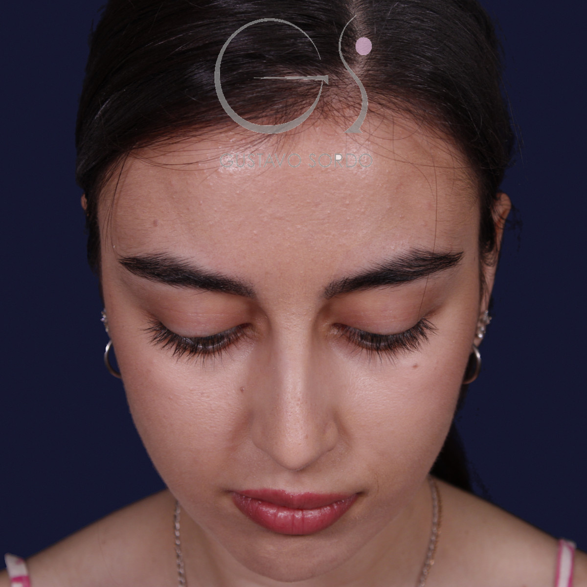 Rinoplastia ultrasónica con tabique desviado y mentoplastia, mentón abajo, antes de la cirugía — caso del Dr. Gustavo Sordo en Madrid