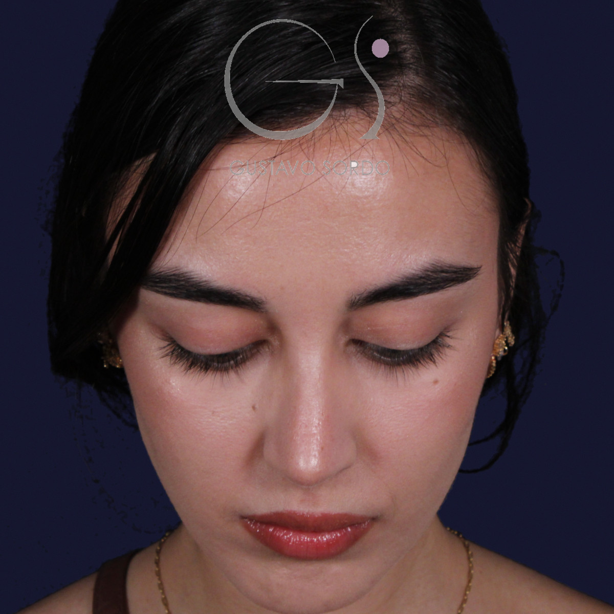 Rinoplastia ultrasónica con tabique desviado y mentoplastia, mentón abajo, al año de la cirugía — caso del Dr. Gustavo Sordo en Madrid