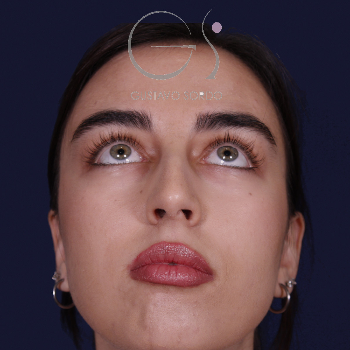 Rinoplastia ultrasónica con tabique desviado y mentoplastia, mentón arriba, antes de la cirugía — caso del Dr. Gustavo Sordo en Madrid