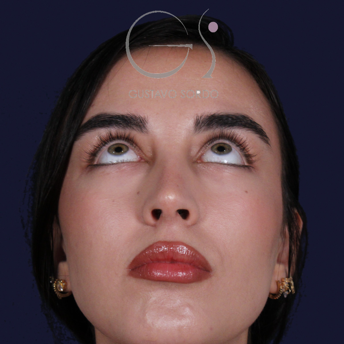 Rinoplastia ultrasónica con tabique desviado y mentoplastia, mentón arriba, al año de la cirugía — caso del Dr. Gustavo Sordo en Madrid