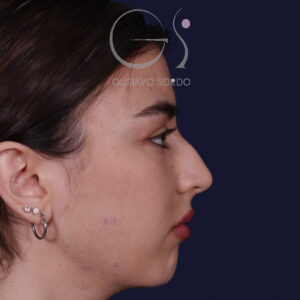 Rinoplastia ultrasónica combinada con mentoplastia — antes. Caso operado por el Dr. Gustavo Sordo en Madrid