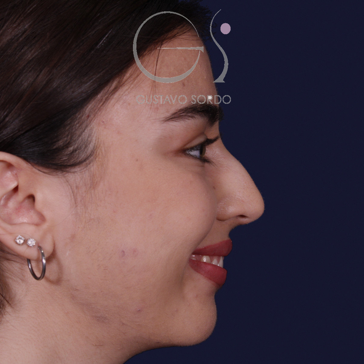 Rinoplastia ultrasónica con tabique desviado y mentoplastia, perfil derecho sonriendo, antes de la cirugía — caso del Dr. Gustavo Sordo en Madrid