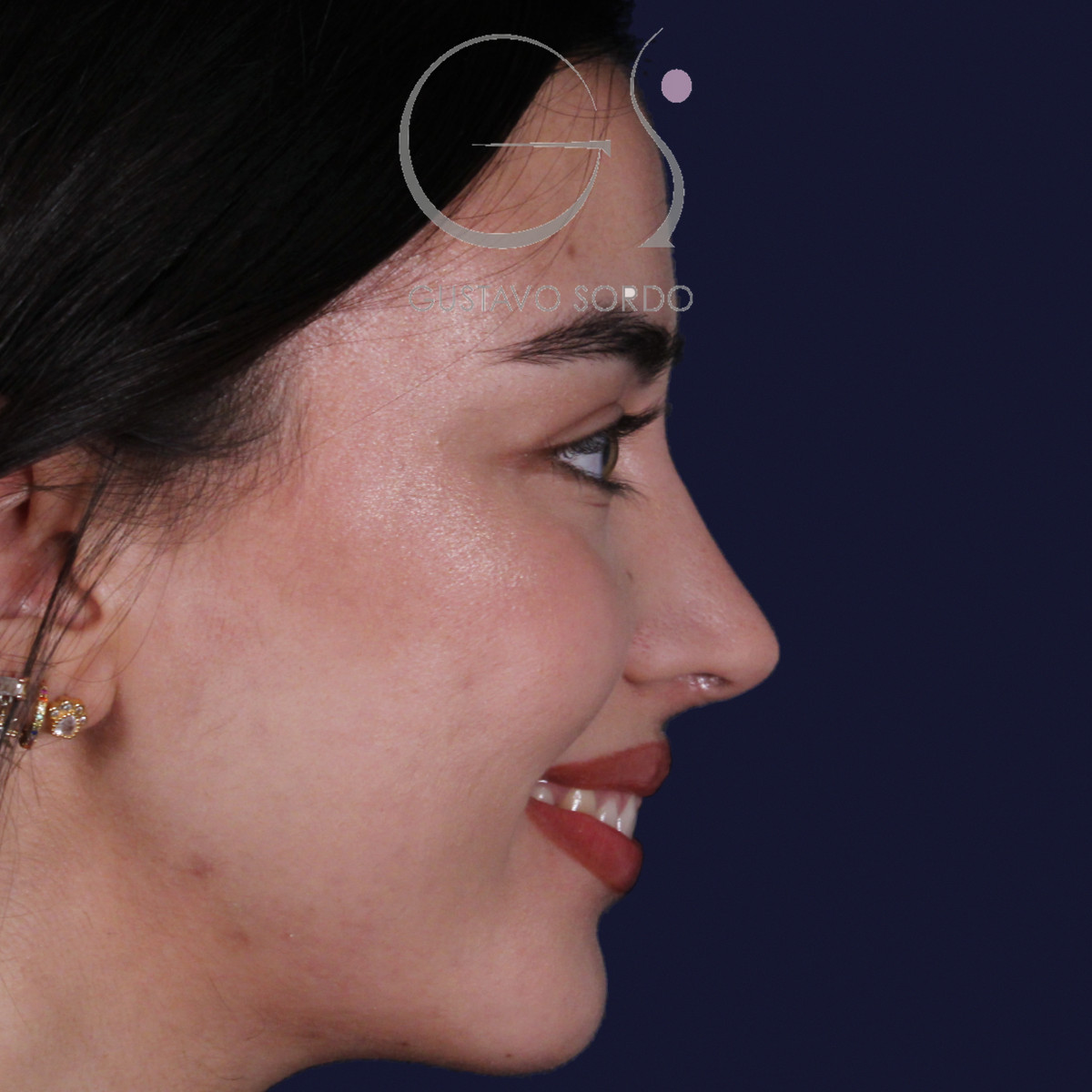 Rinoplastia ultrasónica con tabique desviado y mentoplastia, perfil derecho sonriendo, al año de la cirugía — caso del Dr. Gustavo Sordo en Madrid