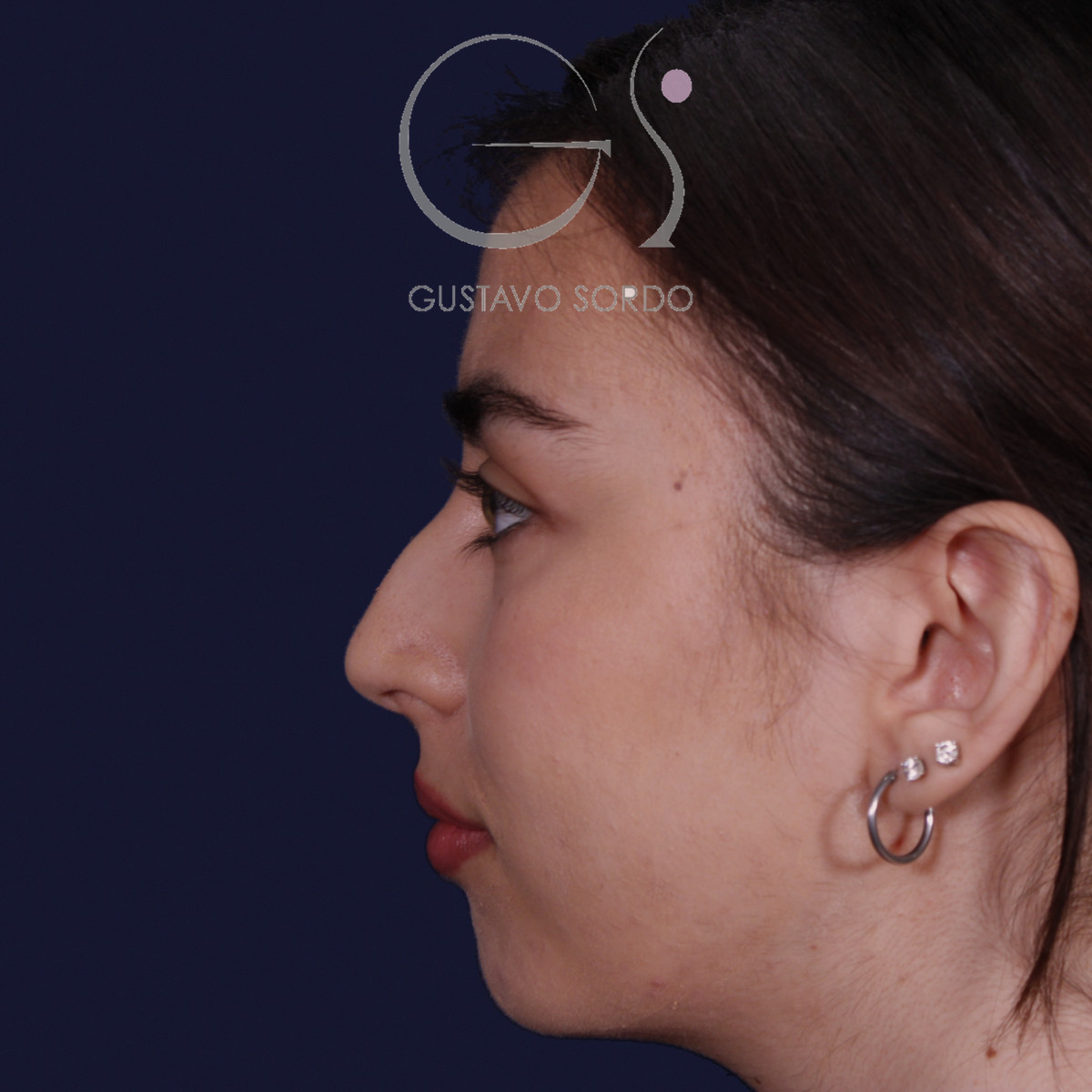 Rinoplastia ultrasónica con tabique desviado y mentoplastia, perfil izquierdo, antes de la cirugía — caso del Dr. Gustavo Sordo en Madrid