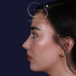 Rinoplastia en Madrid