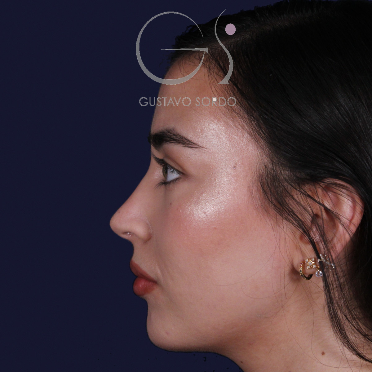 Rinoplastia en Madrid