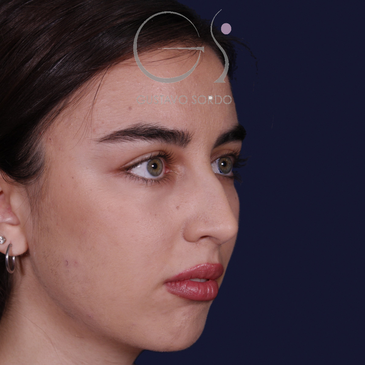 Rinoplastia ultrasónica con tabique desviado y mentoplastia, semiperfil derecho, antes de la cirugía — caso del Dr. Gustavo Sordo en Madrid