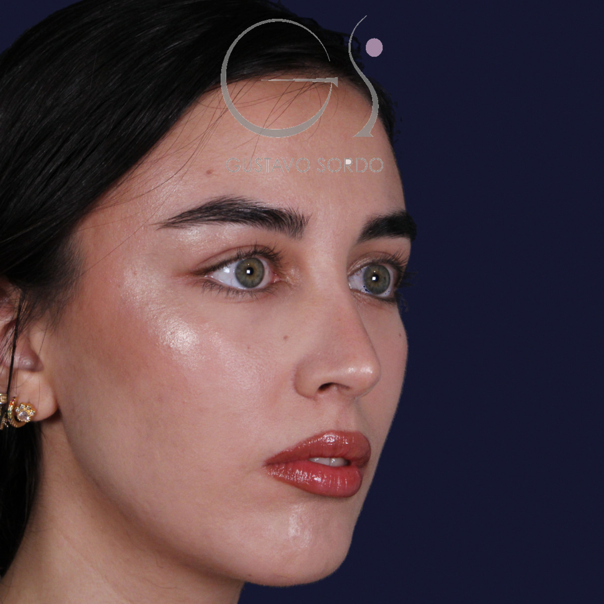 Rinoplastia ultrasónica con tabique desviado y mentoplastia, semiperfil derecho, al año de la cirugía — caso del Dr. Gustavo Sordo en Madrid