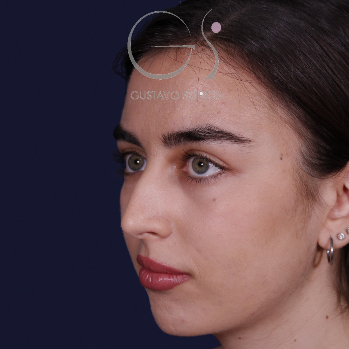 Rinoplastia ultrasónica con tabique desviado y mentoplastia, semiperfil izquierdo, antes de la cirugía — caso del Dr. Gustavo Sordo en Madrid