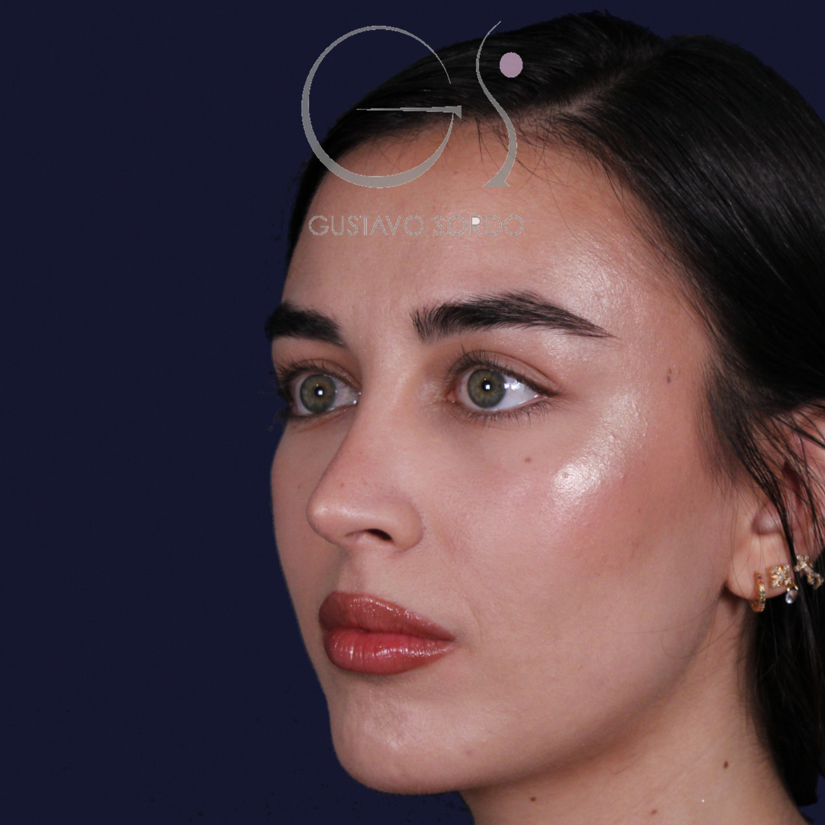 Rinoplastia ultrasónica con tabique desviado y mentoplastia, semiperfil izquierdo, al año de la cirugía — caso del Dr. Gustavo Sordo en Madrid