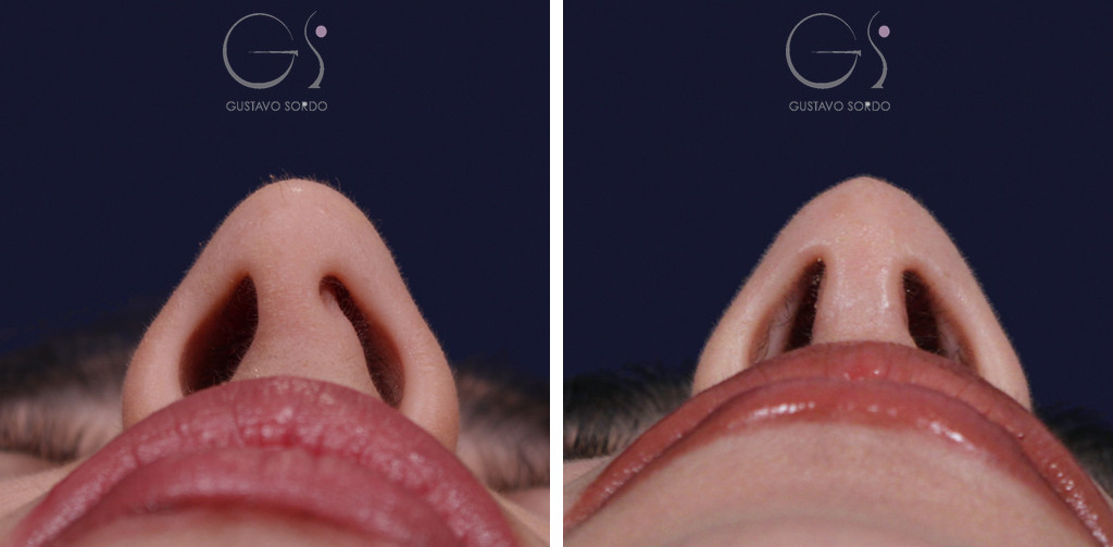 Rinoplastia ultrasónica con tabique desviado y mentoplastia: vista basal antes y al año — caso del Dr. Gustavo Sordo en Madrid