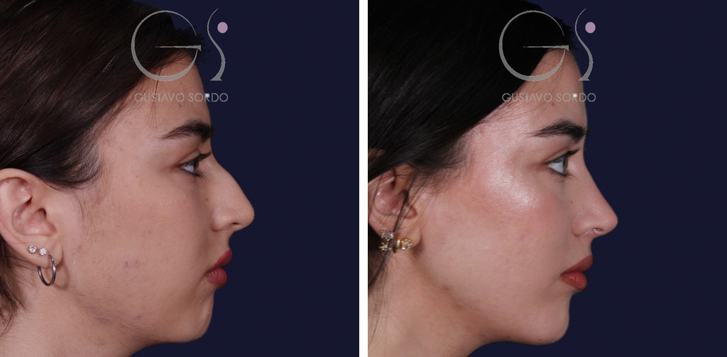Rinoplastia ultrasónica con tabique desviado y mentoplastia: perfil derecho antes y al año — caso del Dr. Gustavo Sordo en Madrid