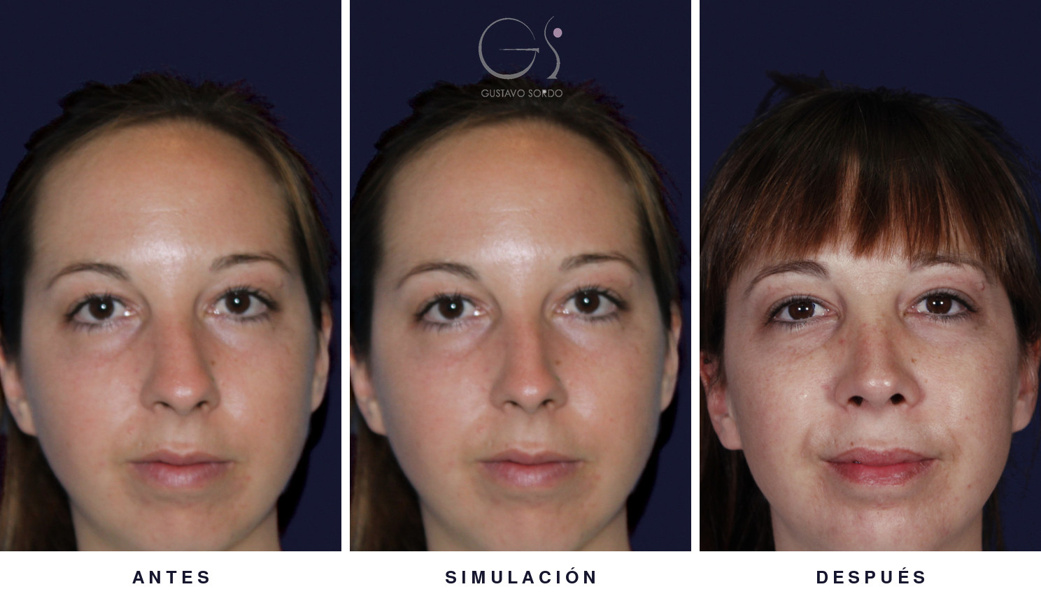Rinoplastia ultrasónica y mentoplastia de frente: antes, simulación y resultado real