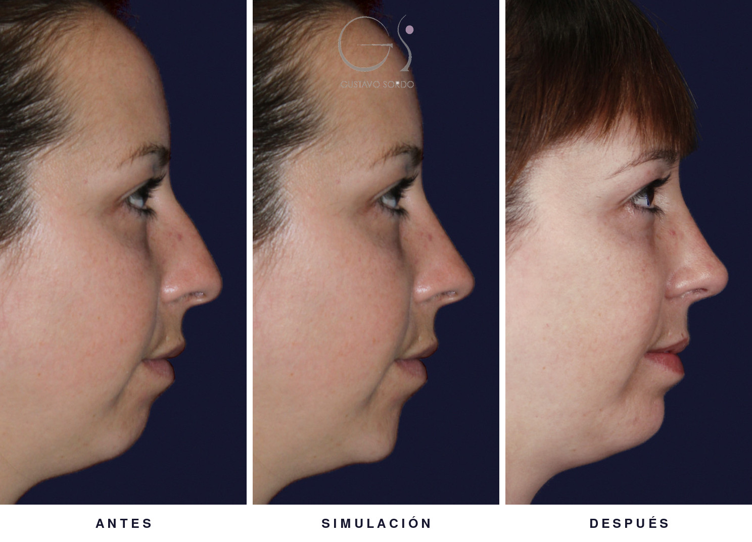 Rinoplastia ultrasónica y mentoplastia: antes, simulación y resultado, de perfil — caso del Dr. Gustavo Sordo en Madrid